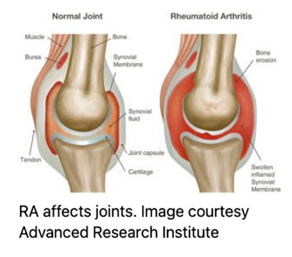 Rheumatoid-Arthritis-1 Barking Dog Shoes reviews and recommends the best footwear for people with various foot issues (as well as for women with average feet for whom comfort is a high priority).
