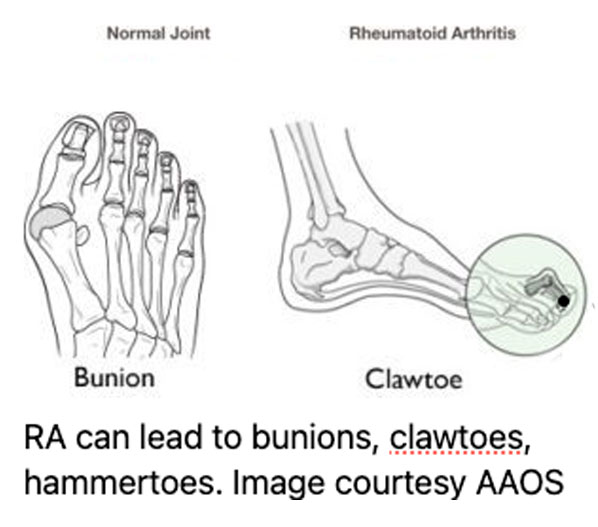 Rheumatoid-Arthritis-2 Barking Dog Shoes reviews and recommends the best footwear for people with various foot issues (as well as for women with average feet for whom comfort is a high priority).